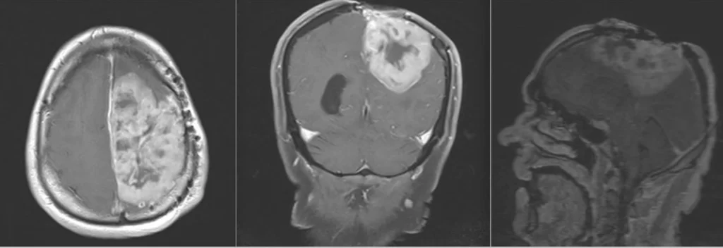 Brain tumors refer to abnormal growths of cells within the brain or the surrounding tissues.