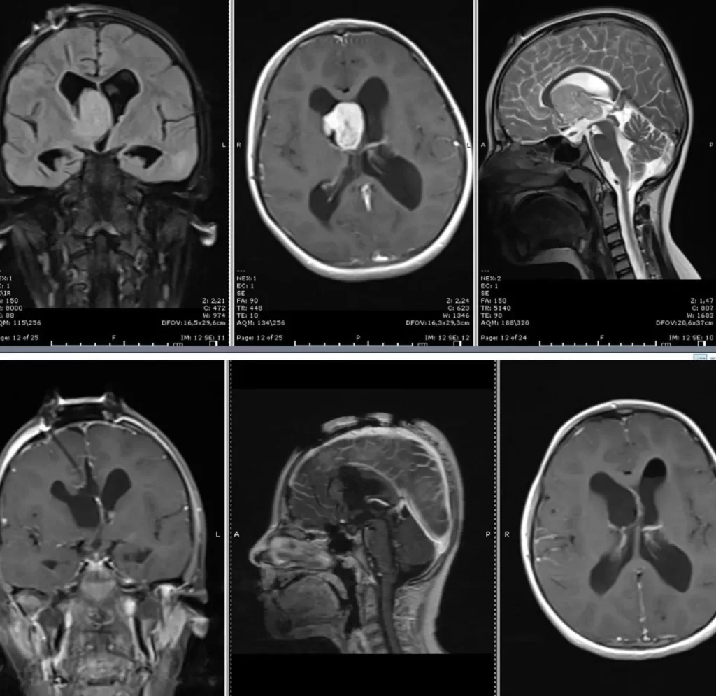 Treatment for brain tumors depends on several factors, including the type, size, location, and grade of the tumor, as well as the patient's overall health and preferences.