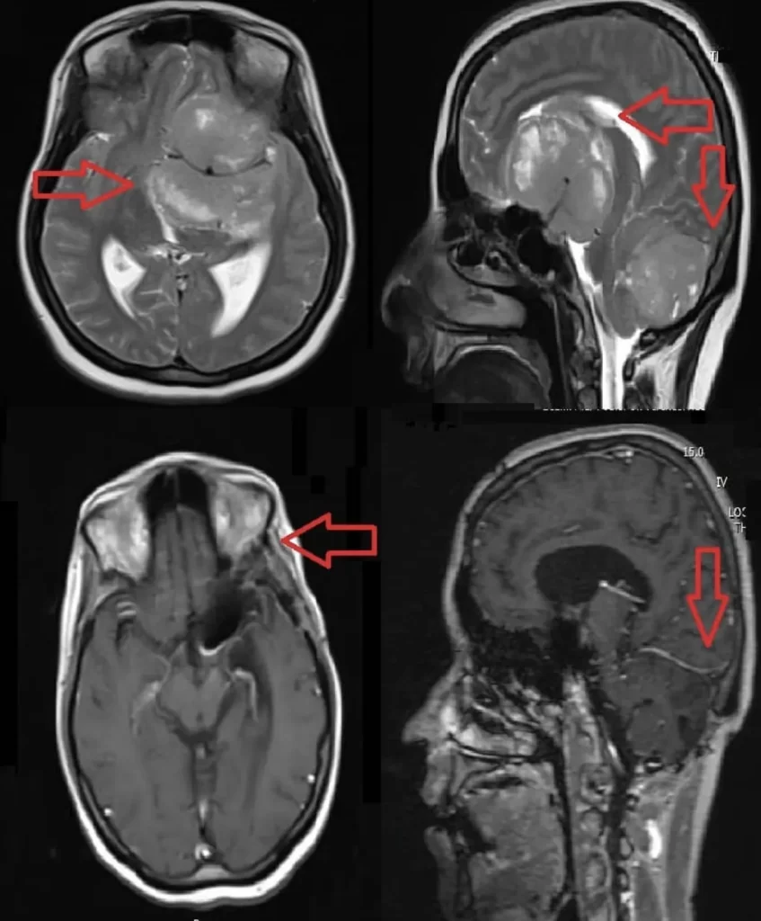 Risk factors for brain tumors can vary depending on the type and characteristics of the tumor. 